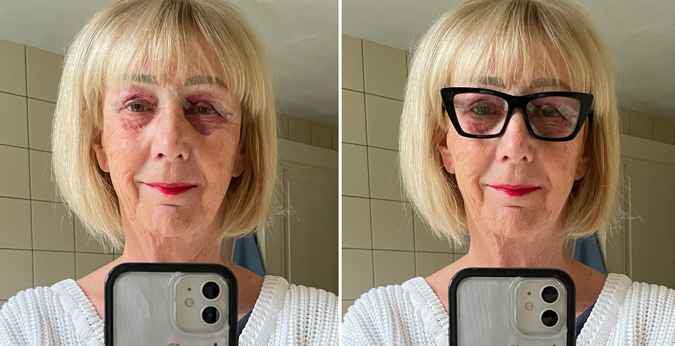 Collage eyelid operation